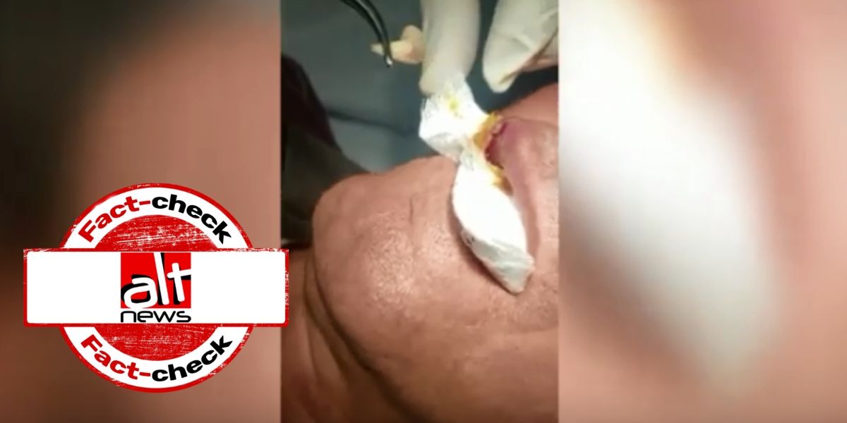 एक व्यक्ति के होंठ से पैरासाइट हटाने का वीडियो, कोरोना वायरस के झूठे दावे से प्रसारित