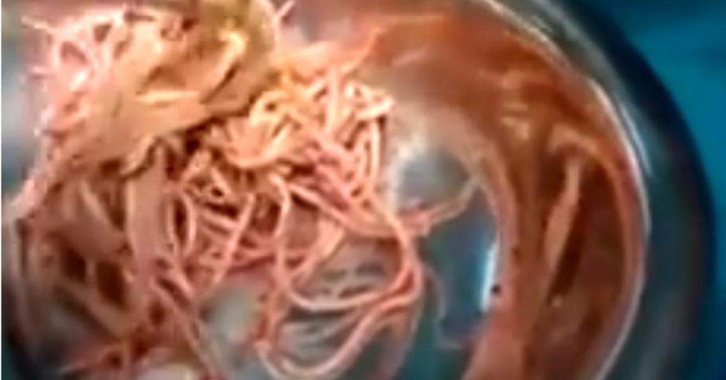 Video of surgically extracted intestinal worms falsely claimed as undigested noodles