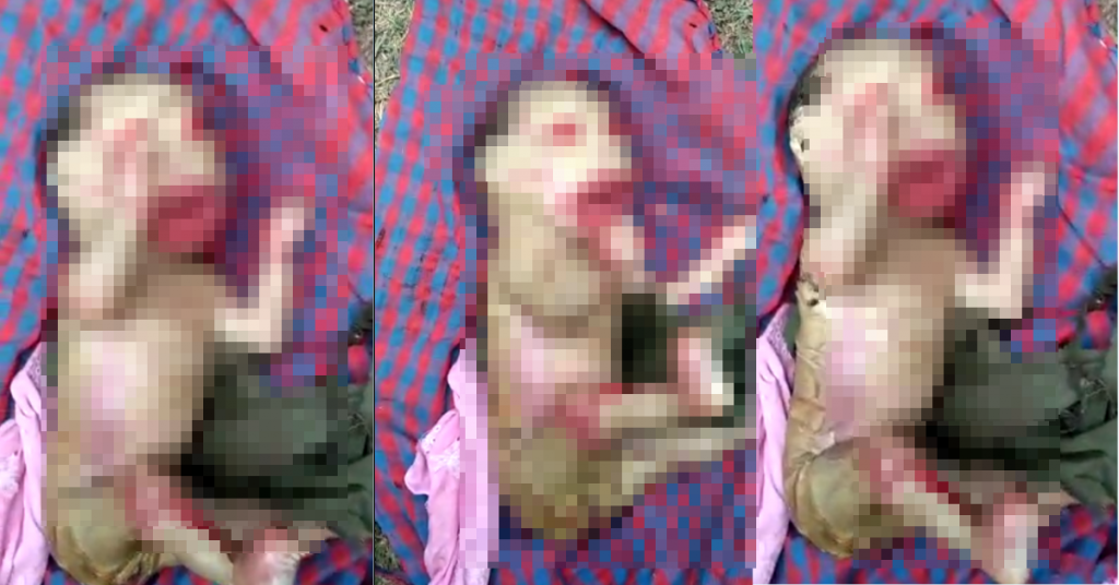 Video of baby suffering from rare genetic disorder shared as ‘demon’ baby born in Assam