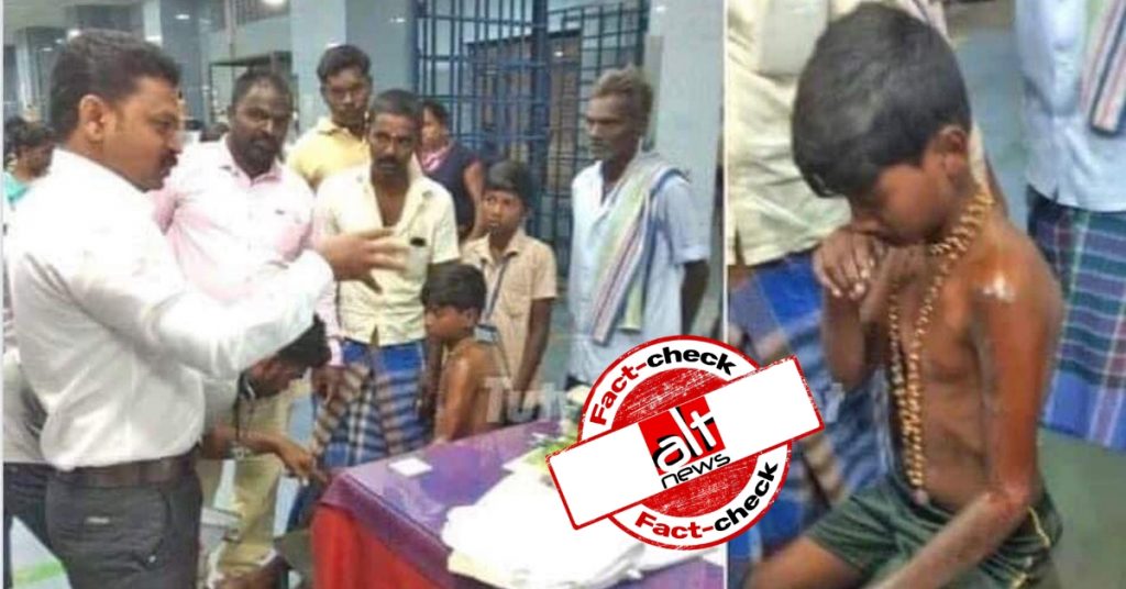 Image of boy with acid burns viral as child punished for wearing Ayyappa necklace in Tamil Nadu school