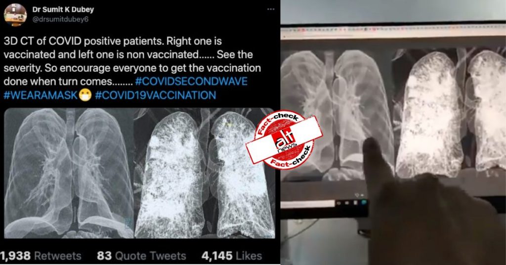 CT scan of lungs of COVID patient viral with misleading vaccine claim